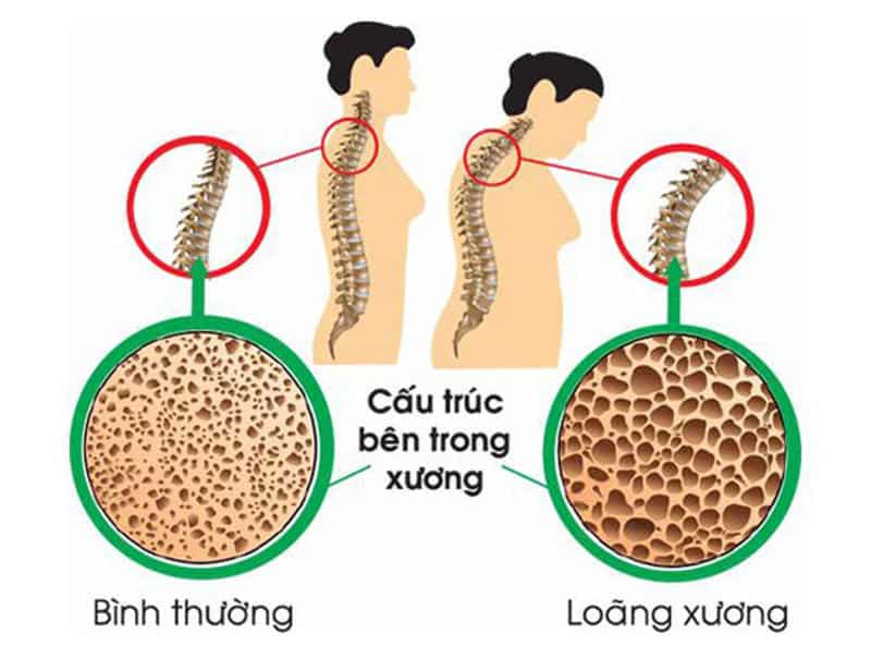 Viên Sủi Mivolis Calcium Bổ Sung Canxi 4 Viên Sủi Mivolis Calcium Bổ Sung Canxi